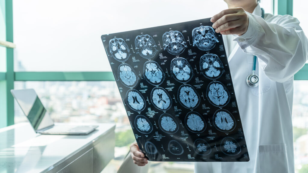 A brain scan image is viewed by a doctor for a patient who suffered a brain injury in a car accident